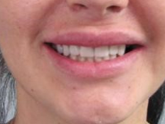Коронки на зубы